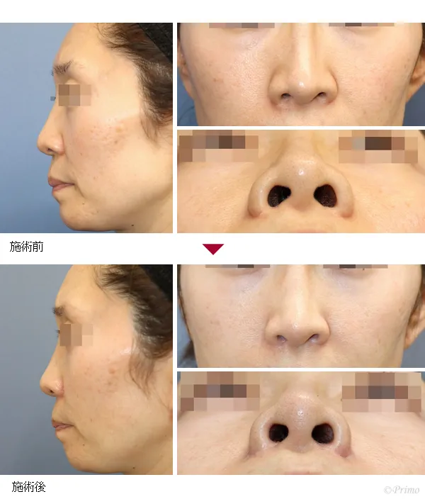 小鼻縮小術による鼻の整形例（プリモ麻布十番クリニックHPより引用）