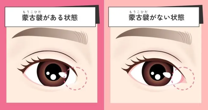 蒙古ひだの解説（ナルビューティークリニックHPより引用）