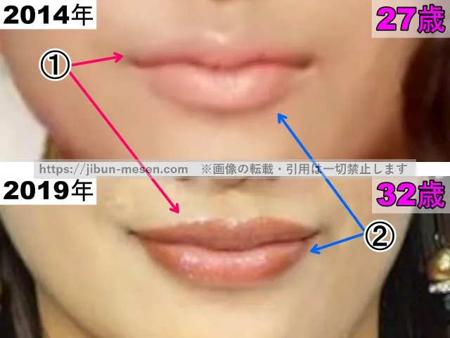高橋メアリージュンの唇の整形検証2014年〜2019年（拡大）