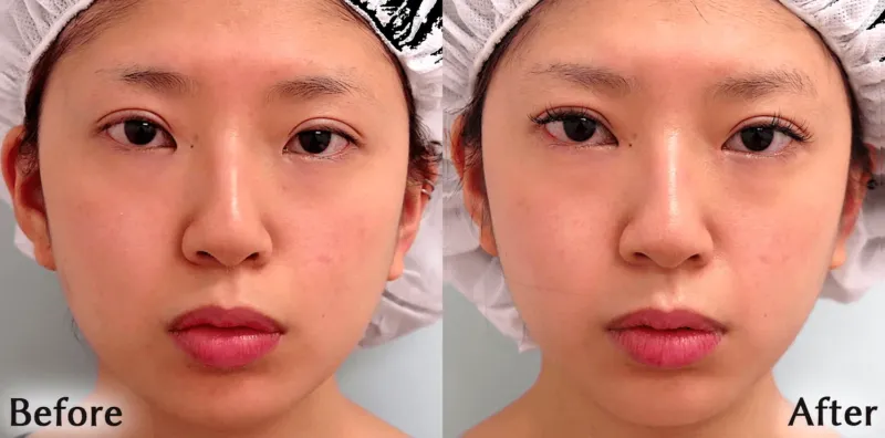 目頭切開による目の整形例(銀座フェイスクリニックHPより引用)