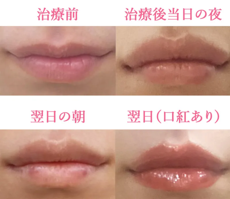 ヒアルロン酸注射による唇の整形例(マグノリア皮膚科クリニックHPより引用)