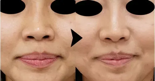 小鼻縮小ボトックス注射による鼻の整形例（もとび美容外科クリニックHPより引用）