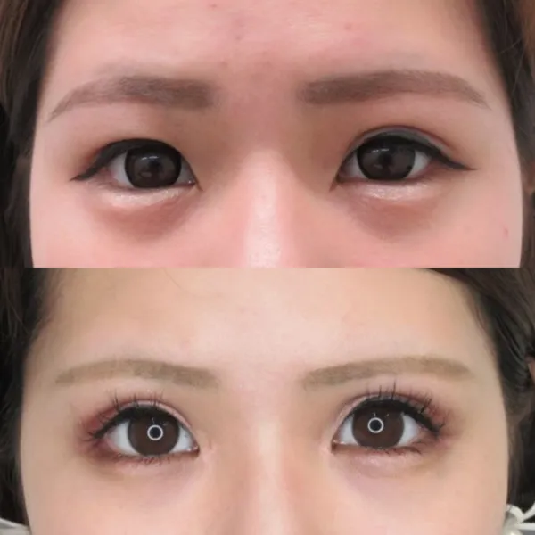 目尻靭帯移動術による目の整形例(TAクリニックグループHPより引用)