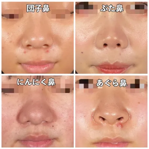 鼻の種類（アールビューティークリニックHPより引用）