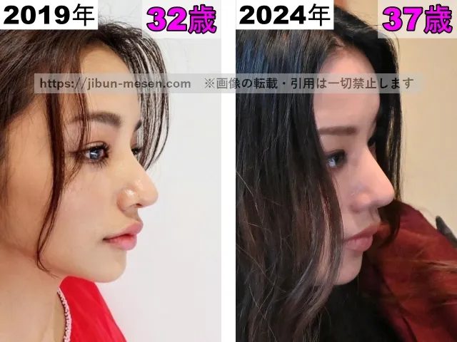 高橋メアリージュンの鼻の整形検証2019年〜2024年（横顔）
