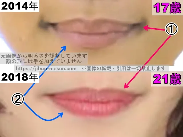 杉咲花の唇の整形検証2014年〜2018年（拡大）