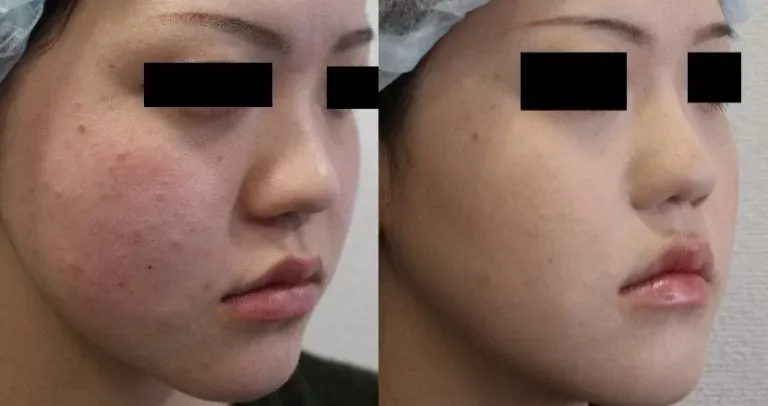 小鼻縮小術による鼻の整形例（船橋中央＆青山セレスクリニックHPより引用）