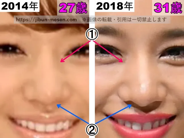 高橋メアリージュンの鼻の整形検証2014年～2018年（拡大）