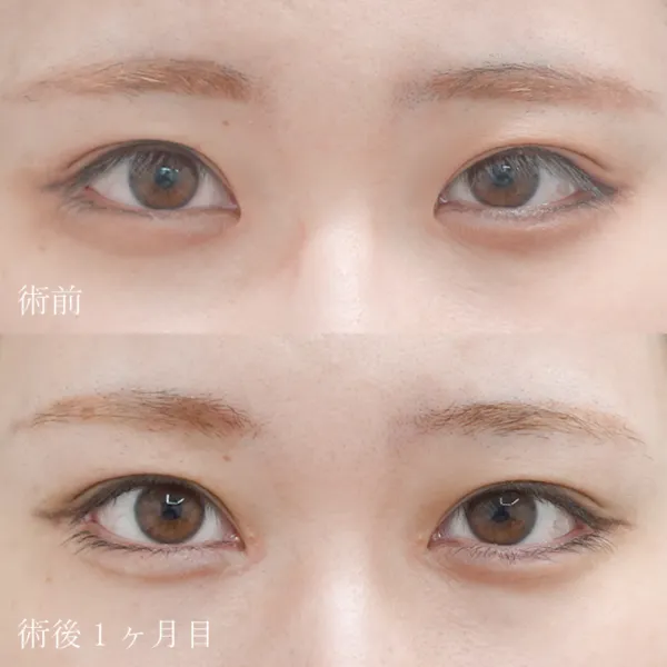 目頭切開による目の整形例（水の森美容クリニックHPより引用）