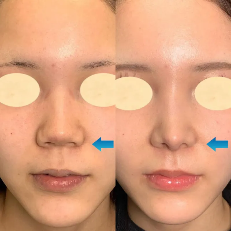 鼻柱下降術による鼻の整形例（eクリニックHPより引用）