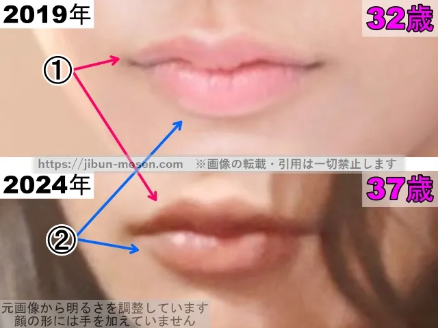 高橋メアリージュンの唇の整形検証2019年〜2024年（拡大）