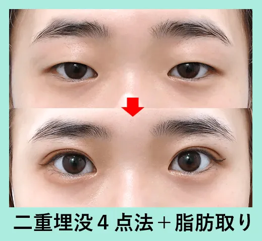 二重埋没法による目の整形例（WOMクリニック銀座HPより引用）
