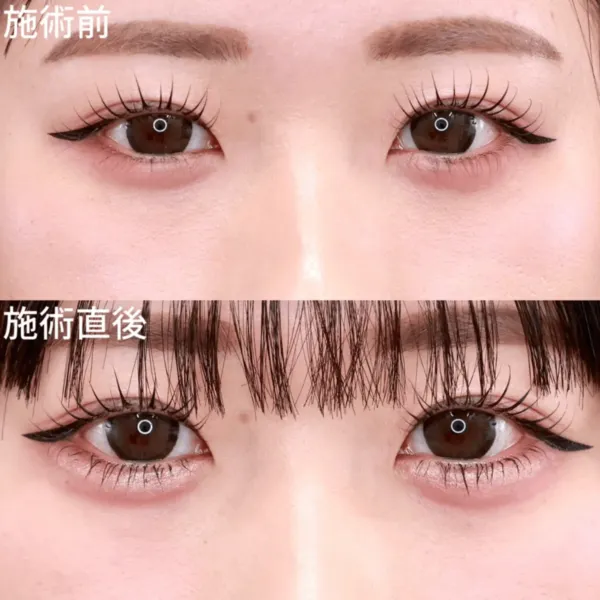 ヒアルロン酸注射による涙袋の整形例(TAクリニックグループHPより引用)