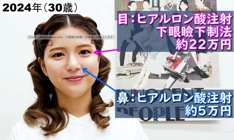 川島海荷が整形した箇所とその費用