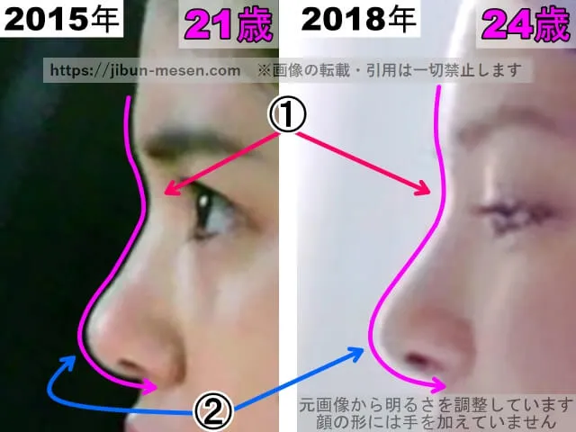 川島海荷の鼻の整形検証2015年~2018年(横顔・拡大)
