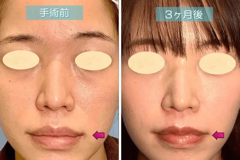 口唇縮小術による唇の整形例（eクリニックHPより引用）