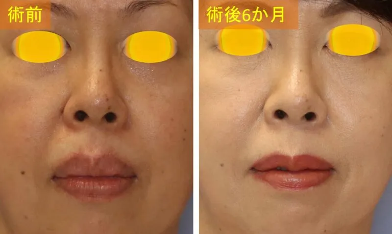 口唇縮小術による唇の整形例（宮益坂クリニックHPより引用）