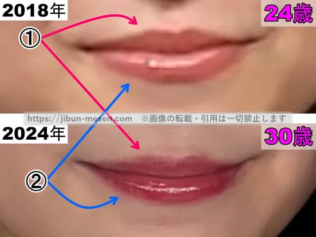 川島海荷の唇の整形検証2018年～2024年（拡大）
