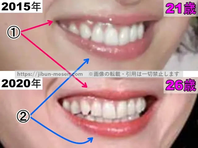 清野菜名の唇の整形検証2015年～2020年（拡大）