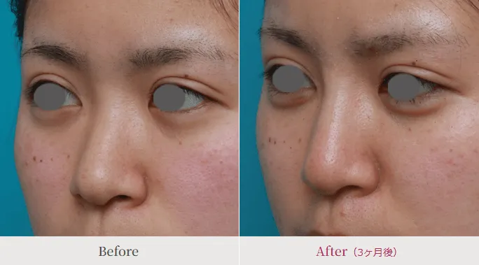 ヒアルロン酸注射による鼻の整形例(高須クリニックHPより引用)