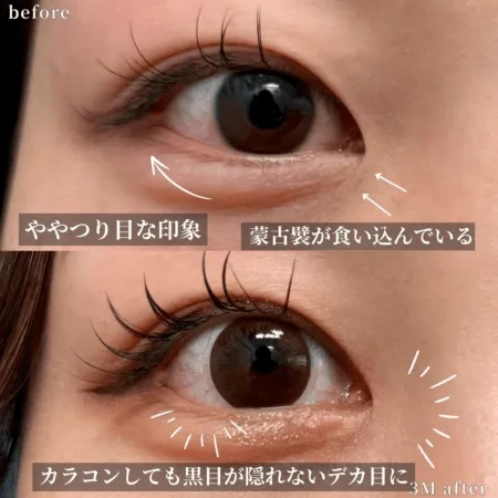 下眼瞼下制法による目の整形例(グローバルビューティークリニックHPより引用)