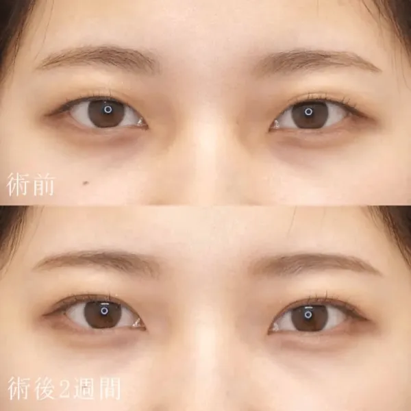 二重埋没法による目の整形例(水の森美容クリニックHPより引用)