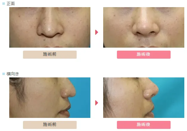 鼻尖挙上術による鼻の整形例（大塚美容形成外科HPより引用）