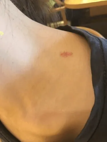 キスマークのサンプル