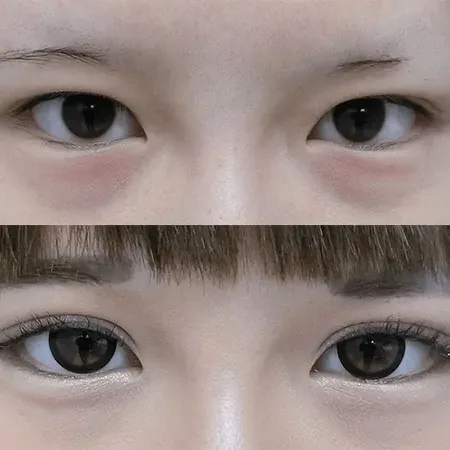 二重切開法による目の整形例(グローバルビューティークリニックHPより引用)