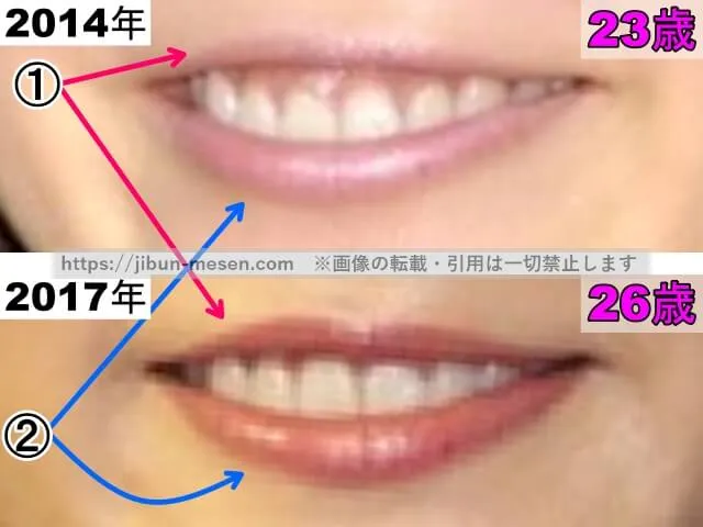蓮佛美沙子の唇の整形検証2014年〜2017年(拡大)