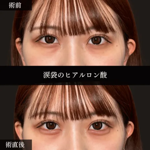 ヒアルロン酸注射による涙袋の整形例（プリズムビューティークリニックHPより引用）