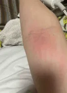 手首を掻いた痕