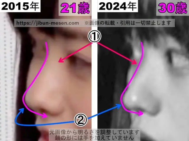 冨手麻妙の鼻の整形検証2015年~2024年(横顔・拡大)