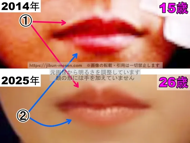 志田彩良の唇の整形検証2014年～2025年（拡大）