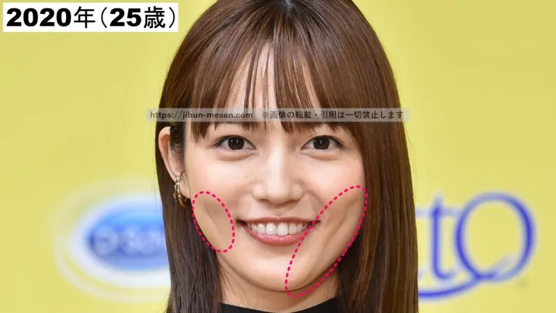 川口春奈の頬の縦筋