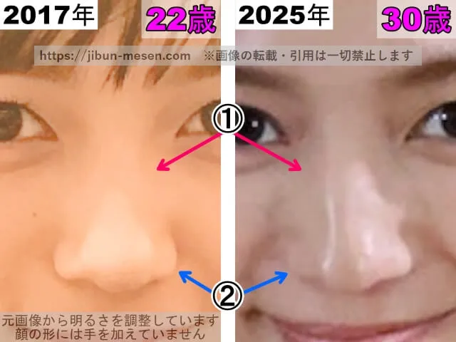 川口春奈の鼻の整形検証2017年~2025年(拡大)
