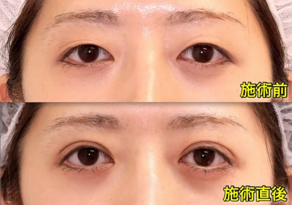 二重埋没法による目の整形例(銀座フェイスクリニックHPより引用)