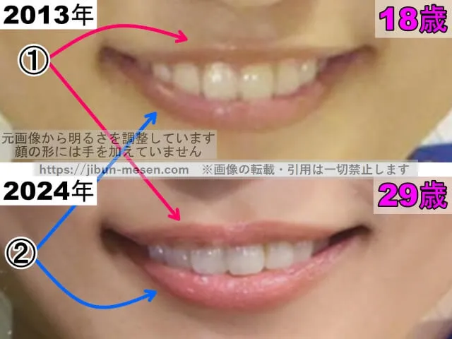 川口春奈の唇の整形検証2013年~2024年(拡大)