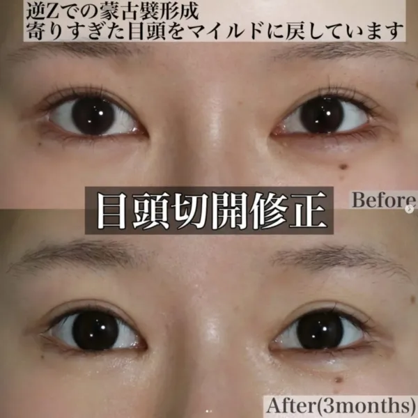 蒙古ひだ修正による目の整形例(マイアミ美容外科HPより引用)