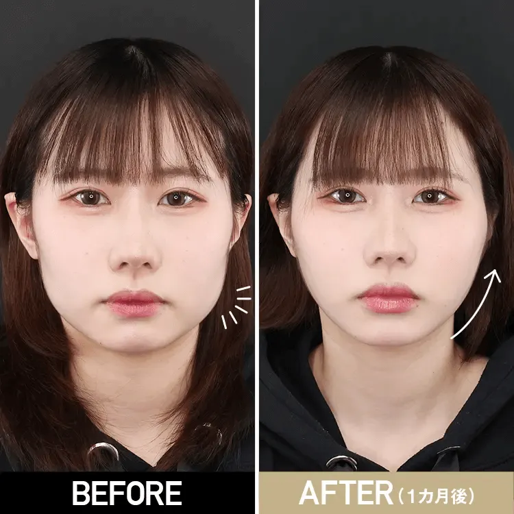 ボトックス注射によるエラの整形例(TAクリニックグループHPより引用)