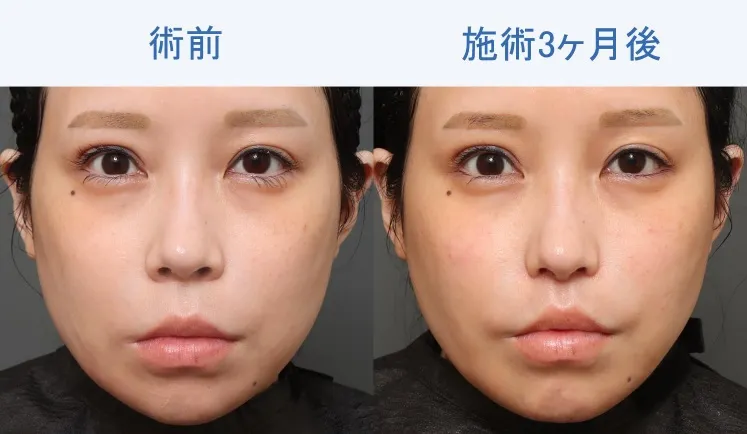 小鼻縮小術による鼻の整形例(オザキクリニックHPより引用)