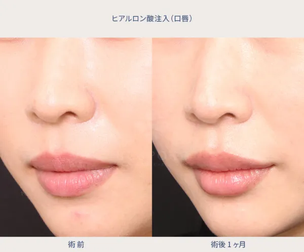 ヒアルロン酸による唇の整形例（ビスポーククリニックHPより引用）