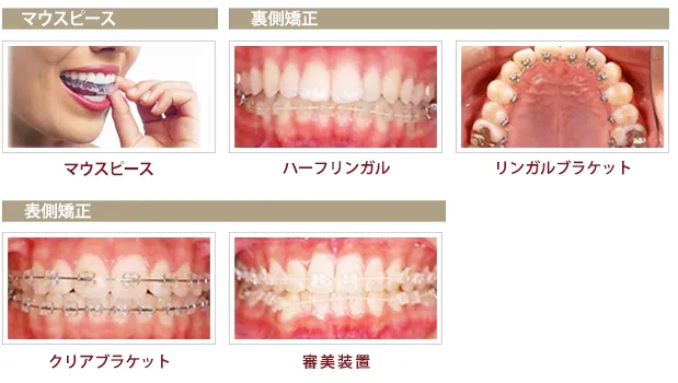 歯の矯正装置の一覧（東京駅前しらゆり歯科HPから引用）