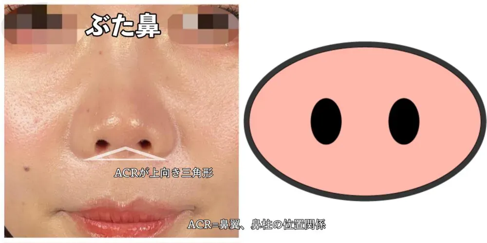 豚鼻の例（アールビューティークリニックHPより引用）