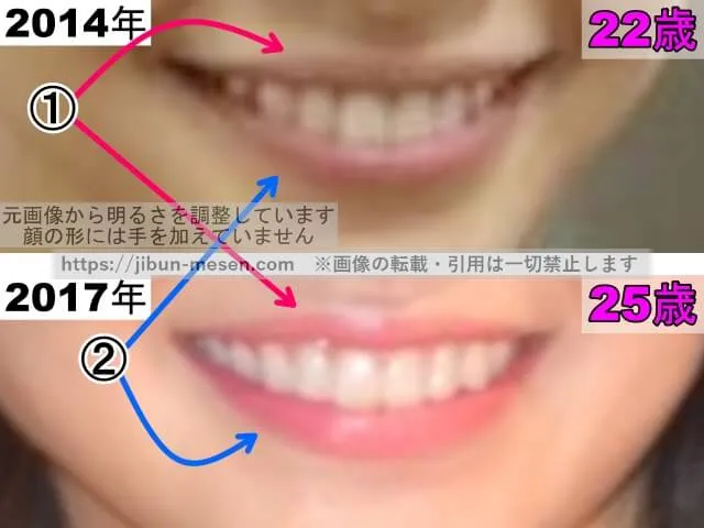 岸井ゆきのの唇の整形検証2014年〜2017年(拡大)