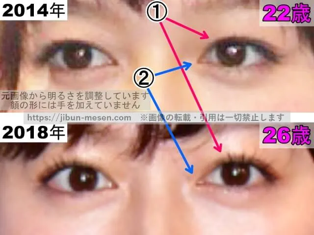 久住小春の目の整形検証2014年～2018年（拡大）