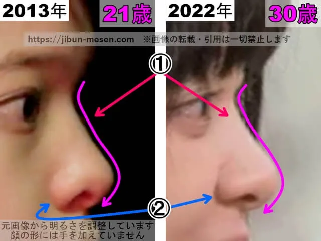 岸井ゆきのの鼻の整形検証2013年〜2022年(横顔・拡大)