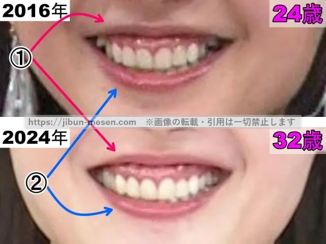 久住小春の唇の整形検証2016年~2024年(拡大)