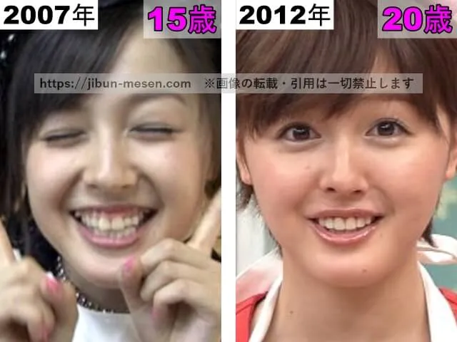 久住小春の唇の整形検証2007年~2012年