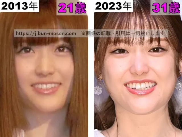 松村沙友理の鼻の整形検証2013年～2023年